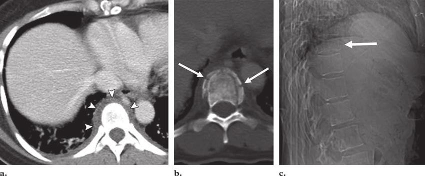 Paravertebralis hematoma