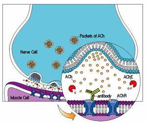 Pathophysiológia anti-achr (IgG1 és 3, C fixálás, keresztkötés) AChR