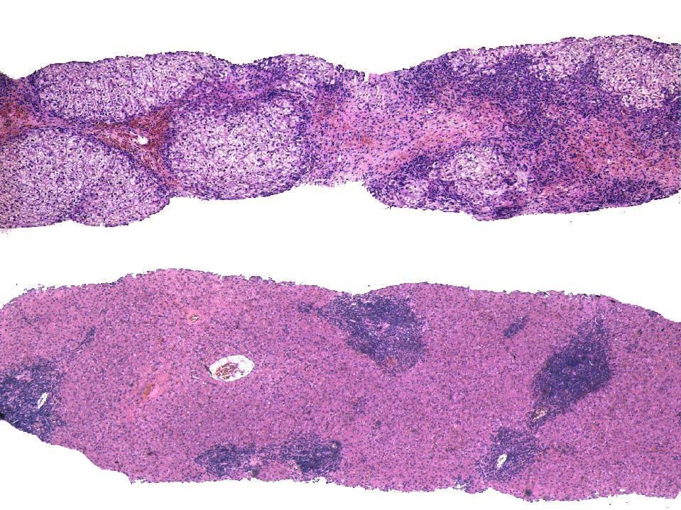 Micronodularis cirrhosis.