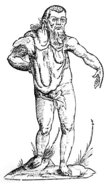 4. ábra: Homuncio, azaz kis ember (törpe) ábrázolása Ulisse Aldrovandi Monstrorum historia című enciklopédiájában (1642) A valós esettanulmányon alapuló ábra mellett azonban ebben a könyvben számos