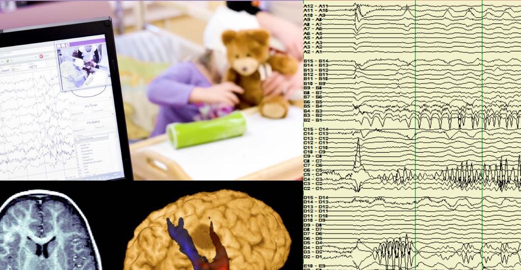 Epilepsziákkal foglalkozó ERH (EpiCARE) Az epilepszia legalább 6 millió embert érint Európában.