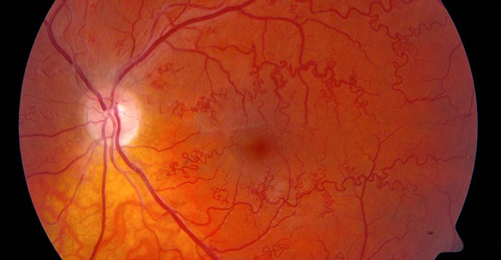Szembetegségekkel foglalkozó ERH (ERN EYE) 20 A ritka szembetegségek (RED) a látásromlás és vakság vezető okait jelentik a gyermekek és fiatal felnőttek körében Európában.