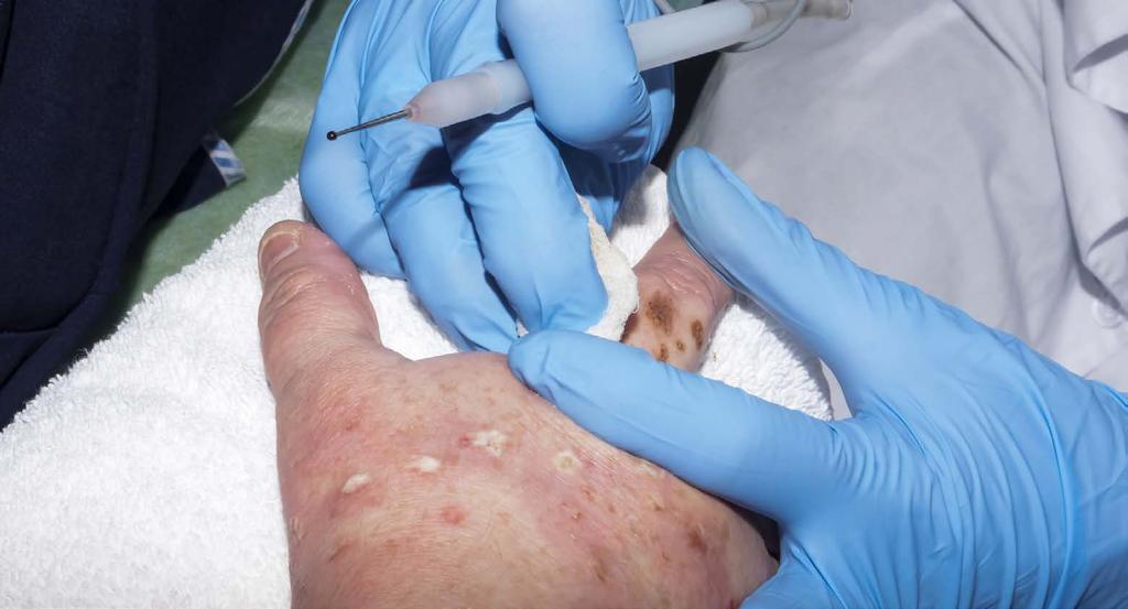 Bőrbetegségekkel foglalkozó ERH (ERN Skin) 34 Sok bőrbetegség súlyos hatással van a betegekre és összefüggésbe hozható a rák kockázatával.