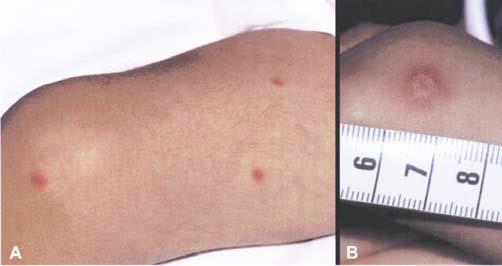 Fusariosis klinikai manifesztációja
