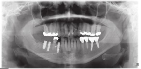 A csontkínálat a moláris régióban implantáció szempontjából horizontálisan és vertikálisan is kíváló volt, további mérésekre nem volt szükség.