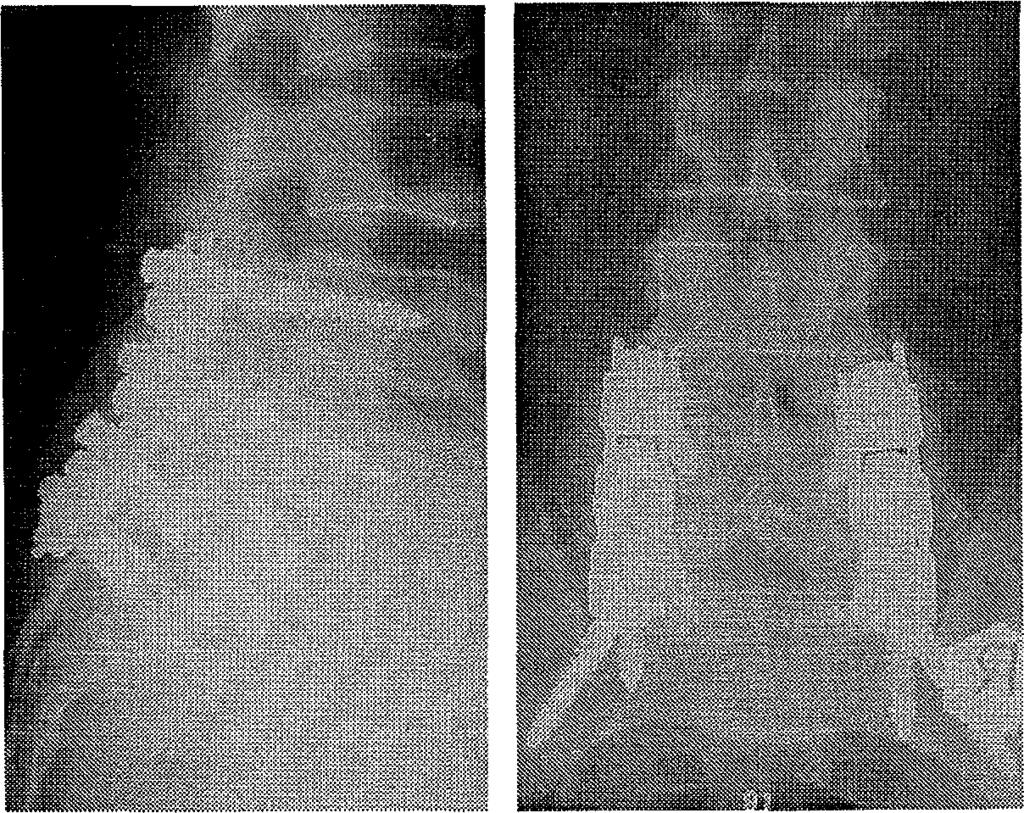 , 41 éves férfi, LIV spondylolysis és -oliysthesis.