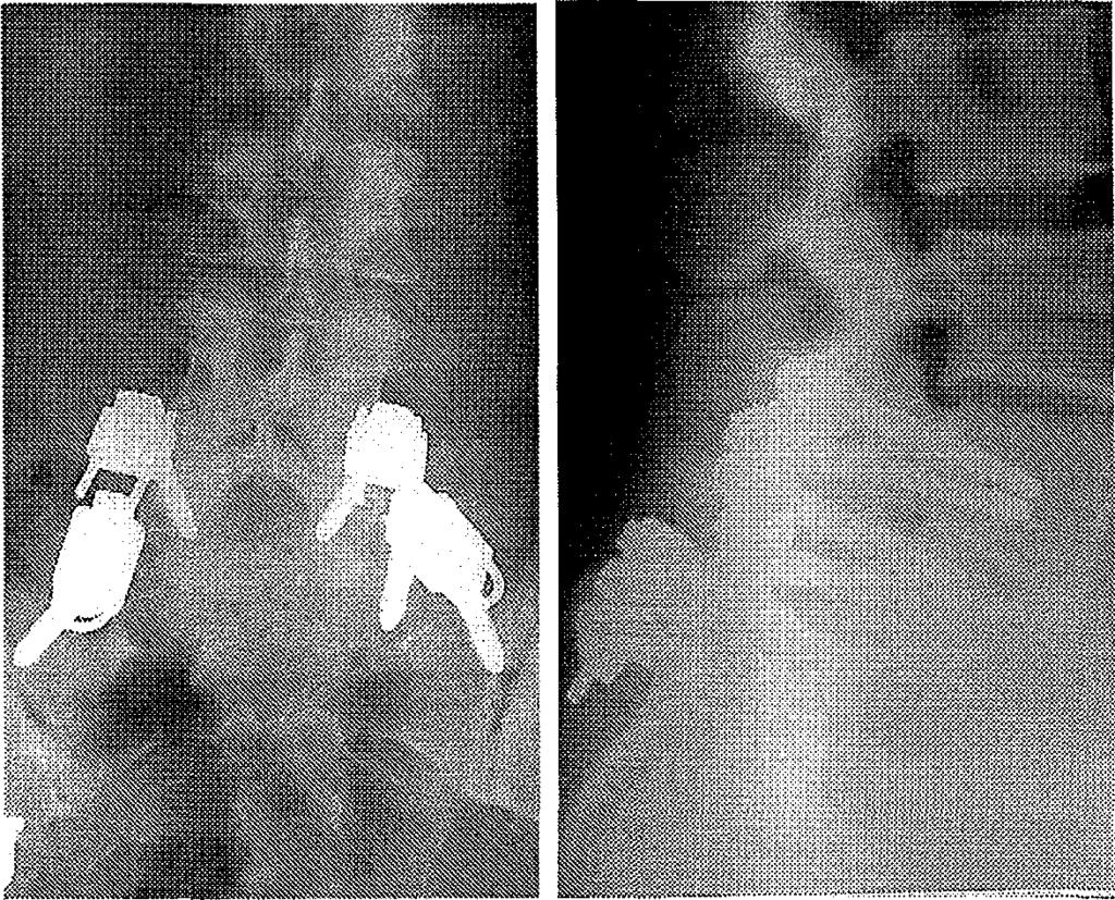 11 41. a. ábra: A Twinflex implantátum hossszanti összekötőjének többszörös törése. 41. b.