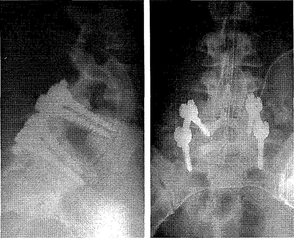 Klinikai eredmények A Zdeblick szerint értékelt klinikai eredmények megoszlását táblázatban szemléltettük (8. táblázat).
