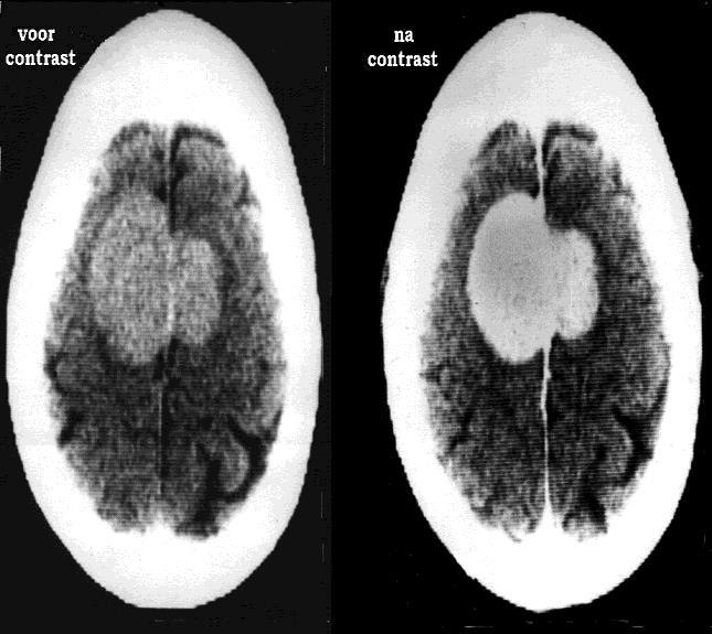 neurodegeneratív (Fronto-temporális demencia,