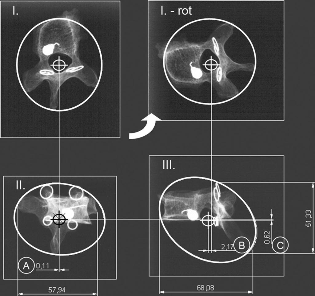 E986 Spine Volume 31 Number 26 2006 Figure 4. Three-dimensional geometrical determination of the spatial mechanical center of the vertebra. The Examination of the Change in Volume of the Spinal Canal.