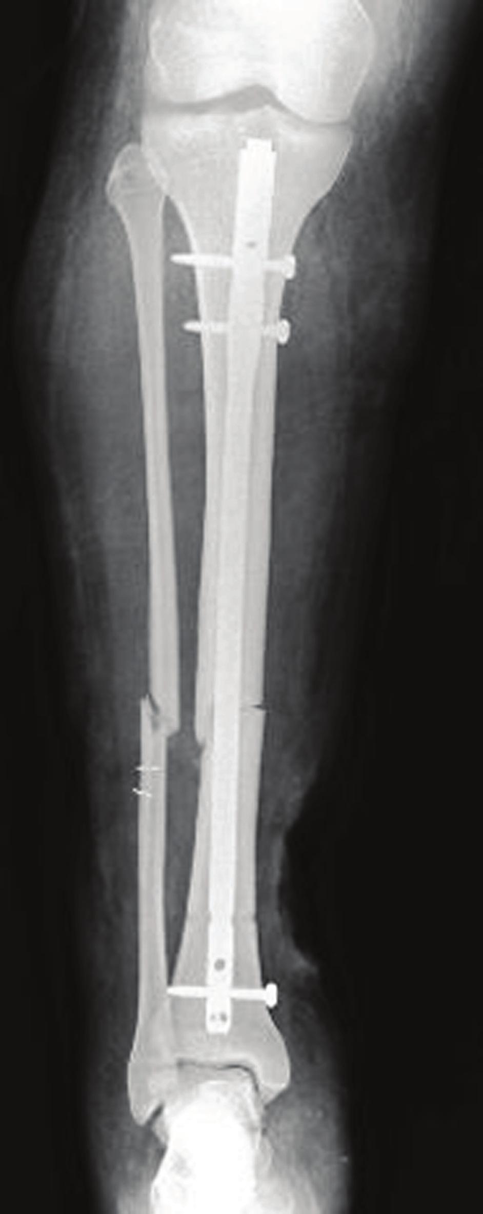 a result of circulating bacteria that are present after major trauma. 10 Due to these controversies, the treatment algorithm is very important.