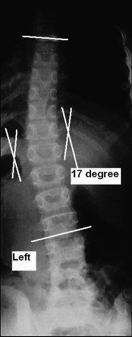 The radiologic assessment of the cervical spine (Figure 5) revealed an atlanto-occipital subluxation and a Klippel-Feil syndrome, symmetric