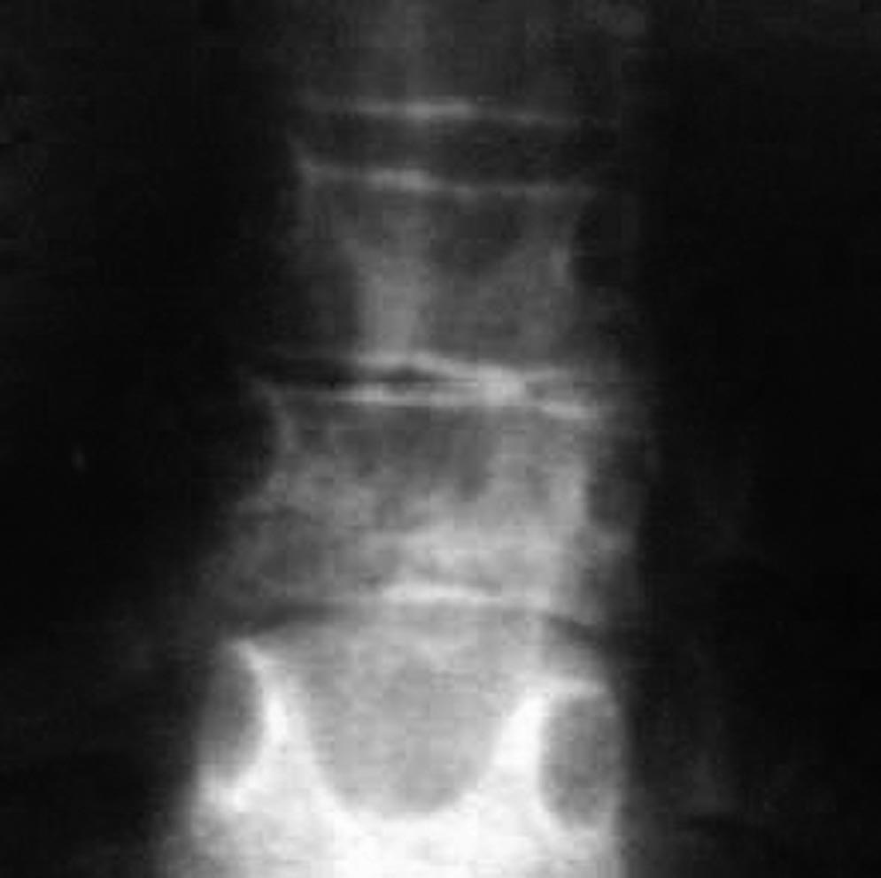 The MRI scans ruled out the abnormality of the spinal cord and roots.