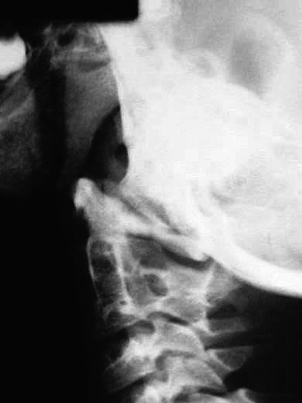 Occipitoatlantoaxial Instability in PRS Molnár et al E503 Figure 7. The axial computed tomography scan shows the dysplastic lateral mass and the subluxation of the atlas. Figure 5.