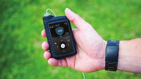 Ezúttal a Medtronic cég MiniMed 670G jelű hibrid zártrendszerű (closed loop) inzulinpumpájáról van szó, mely folyamatosan össze van kapcsolva egy szöveti glukózmonitorral, mely 5 percenként méri a