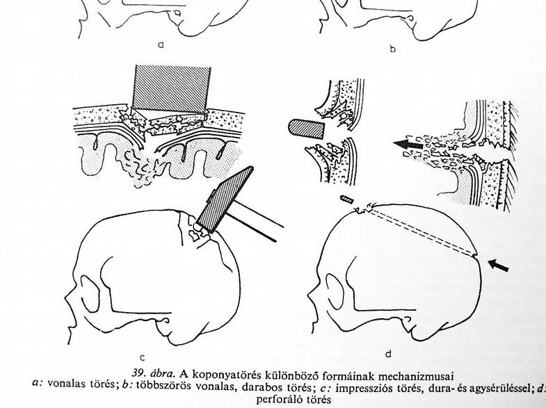 Koponya törések Direkt trauma Calvaria törésekek: egyszerű vonalas törés darabos