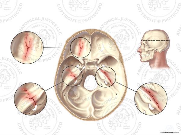 Koponya törések Basis törések: elülső scala pápaszem hematoma, liquor csorgás orrból pyramis törés (középső