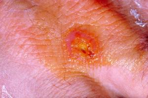 A tularemia klinikai tünetei Pörk a
