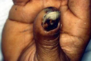 tularemiás nyúl harapás után Bőr ulceráció