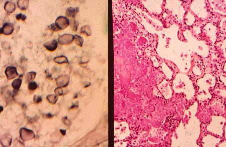 RÁGCSÁLÓK ÉS NYÚL TERJESZTETTE PROTOZOON ZOONÓZISOK PNEUMOCYSTIS CARINII Jellemzők: gomba v.