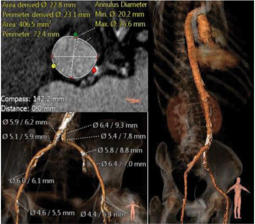 1. ábra Az angió CT alapján készült rekonstrukciós képek. Bal oldalon felül az aorta anulus keresztmetszeti képe és a billentyűméret kiválasztásához használatos mérések.