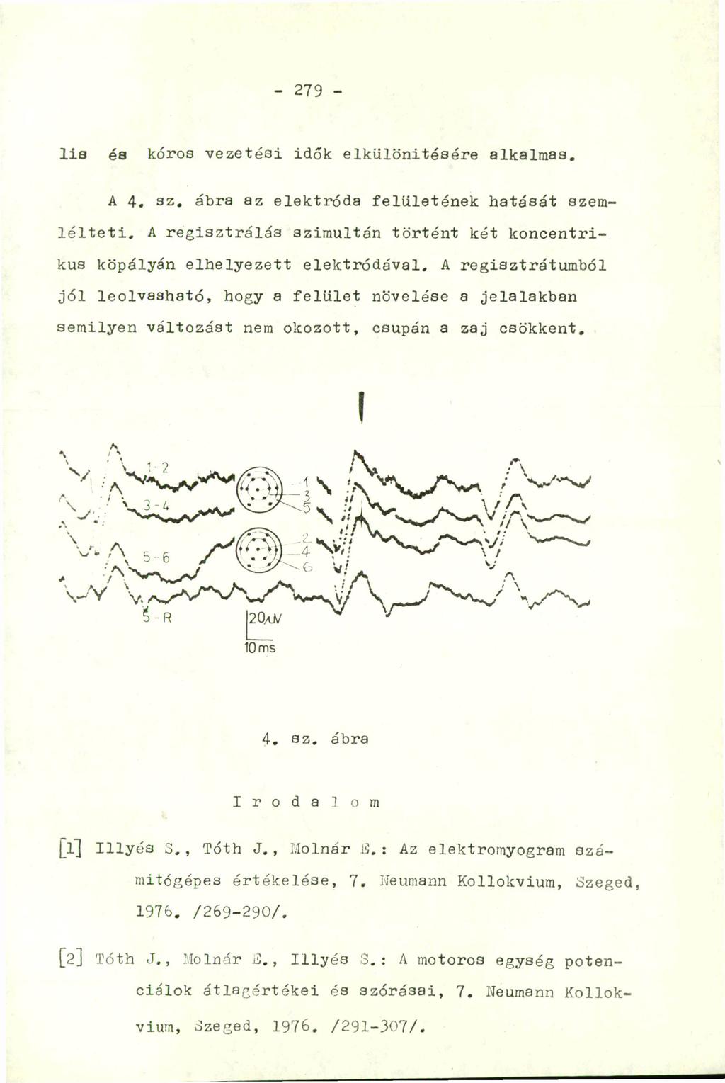 279 lis és kóros vezetési idók elkülönítésére alkalmas. A 4. sz. ábra az elektróda felületének hatását szemlélteti, A regisztrálás szimultán történt két koncentrikus köpályán elhelyezett elektródával.
