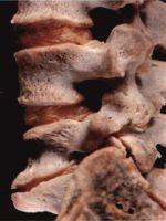 Védekezésképpen fokozott izomműködés, később meszes csontkinövések (osteophiták) keletkeznek, amelyek