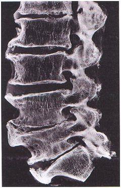 porcrés magassága csökken A stabilizáló szalagok ellazulnak A csigolyák peremszélein csontos felrakódások