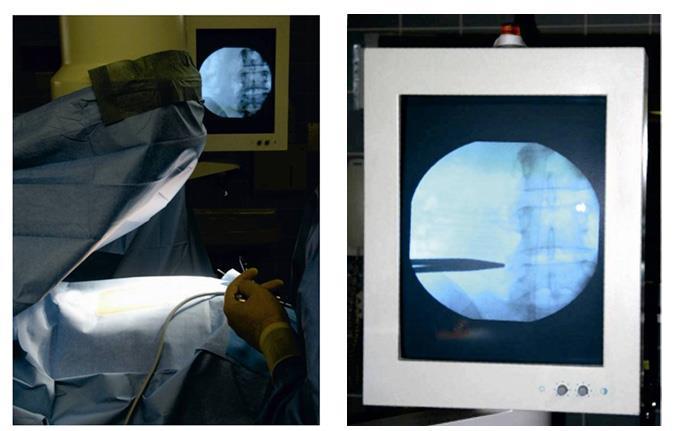 A műtét menete: Röntgen képerősítő segítségével megjelöljük a szűkület magasságát, az instabilitás helyét. 7.