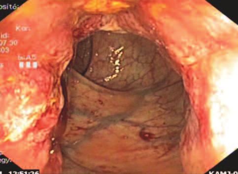 Melan A HMB45 1. ábra. Melanoma malignum a rectumban (1. eset) (0,25 µg/l) volt kiemelhető. A betegnél r2 abdominoperinealis rectumexstirpatio történt, 13 nyirokcsomóból kettőben igazolódott áttét.