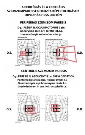 Szemmzgás zavark diagnsztikai lehetőségei megtarttt tudatú betegnél * kettőskép elemzés * szenzrs tesztek után Megtekintés primer szemállás Fejtartás -