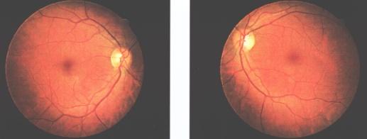 kitakaráss (uncver) teszt Kiegészítő tesztek: cclusiós teszt, trzió vizsgálata, hármlépéses teszt, Babafejmanőever ( Oculcephalicus reflex) Vezetett