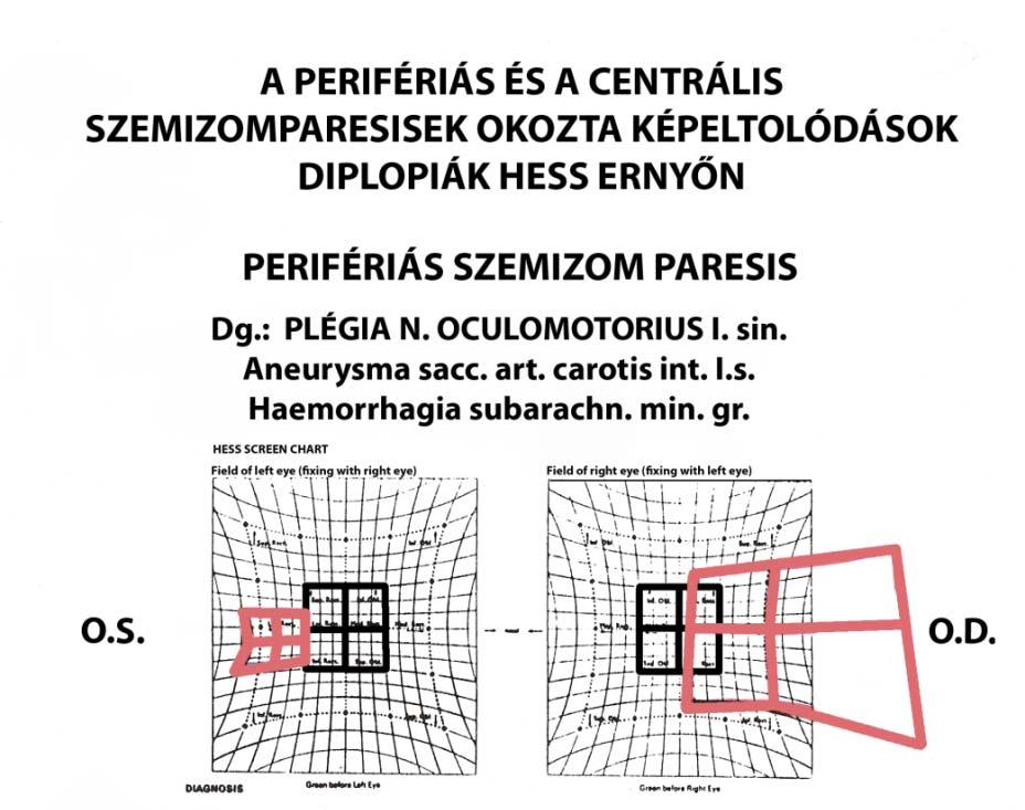 Differenciál diagnózis Perifériás paresis nagy kép diszparáció legnagybb PD-val sem krrigálható Th.