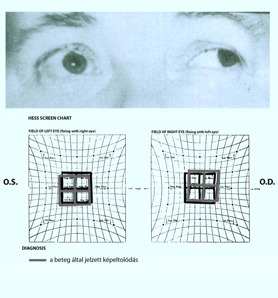 Az ún. cularis tilt szindróma agytörzsi funkciózavar Ocularis tilt tünet együttes 1./ ferde, nem kmpenzáló fejtartás 2.
