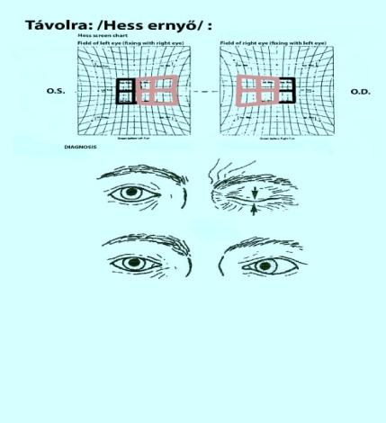 Agytörzsi ABDUKCIÓS tekintési paresis