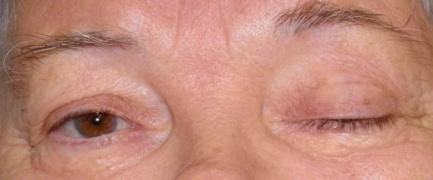 Myasthenia gravis Ocularis Myasthenia gravis (OMG) OMG - szemmzgászavar