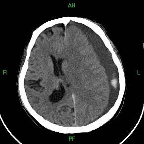 Obstrukciós hydrcephalus liqur