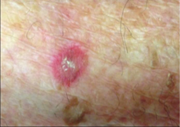A fagyasztást követően erythema, oedema, hólyagok, infekció, hegek, illetve tartós hypo- vagy hyperpigmentáció alakulhat ki (21, 27, 28).