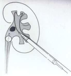 ureteroscopia Percutan nephrostomia 1869 -