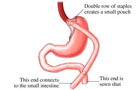 Gastric bypass surgery gyomorszűkítő műtét - a fogyás leghatékonyabb