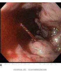 Esophagealvaricealbleeding 20% mortalityin6 weeks Survival after variceal hemorrhage has improved in the last decades(use of antibiotics and variceal ligation) Portal pressure gradient >12 mmhg