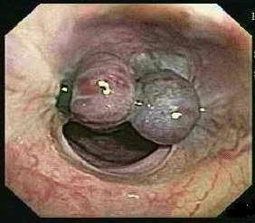 Endoscopicvaricealligation Superior to EST Recurrent bleeding Local adverse