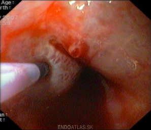 Endoscopicsclerotherapy Largevarietyof Sclerosants Concentrations Volumes Treatment intervals if EVL is technically difficult