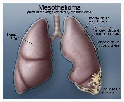 Foglalkozási porártalmak Azbeszt okozta mesothelioma Lefolyás: az