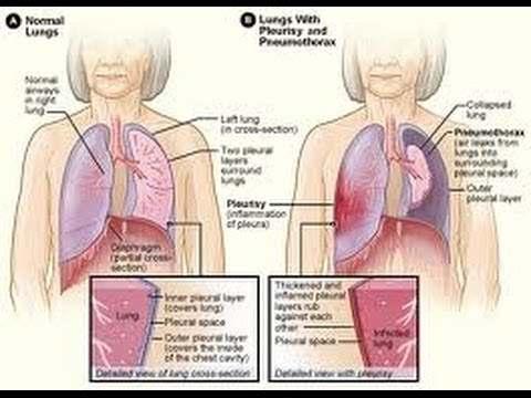 Nem daganatos megbetegedések: Azbeszt okozta egészségkárosodások Pleura megvastagodás, pleurális plakkok Azbesztózis Daganatos megbetegedések: Tüdő és bronchuscarcinoma Mesothelioma Foglalkozási