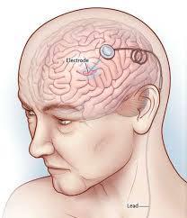 PACEMAKEREK Kezelt betegségek: Parkinson-kor Anorexia Epilepszia Migrén Depresszió