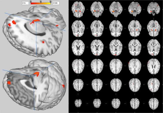 Szociális szorongás zavar Proposed neurobiological model of SAD. All regions shown here are more active in SAD than in HCS.