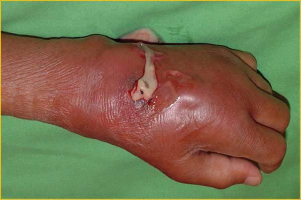 Septicus arthritis incidenciája 40-68/100000/ év protézis