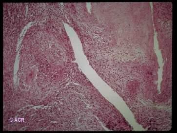 Pathogenesis BAKTÉRIUM INVÁZIÓ ENDOTOXINOK, EXOTOXINOK S.