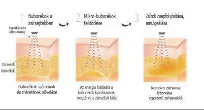 A kezelés során nagy teljesítményű ultrahang hullámok a kezelt terület szöveteiben mikrobuborékokat hoznak létre, ezért az eljárás nem igényel fizikai beavatkozást.